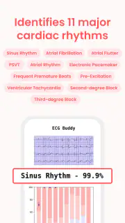 ECG Buddy | ECG Analysis AI screenshot 3