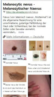 Model Dermatol – Hautkrankheit screenshot 2