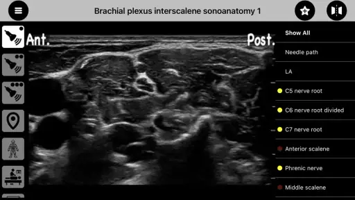 AnSo Anaesthesia Sonoanatomy screenshot 3