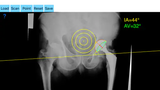CupAnteversionInclinationApp screenshot 6