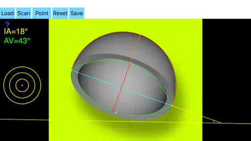 CupAnteversionInclinationApp screenshot 8